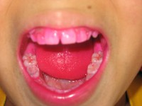 /album/fotogaleria-inicio1/detector-de-placa-microbiana-jpg1/